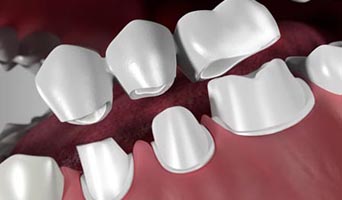 Benefits of Dental Bridges Treatment