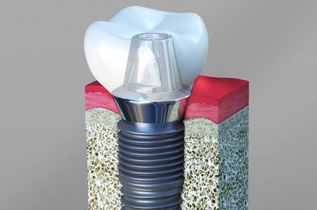 Dental Implants Cathedral City California